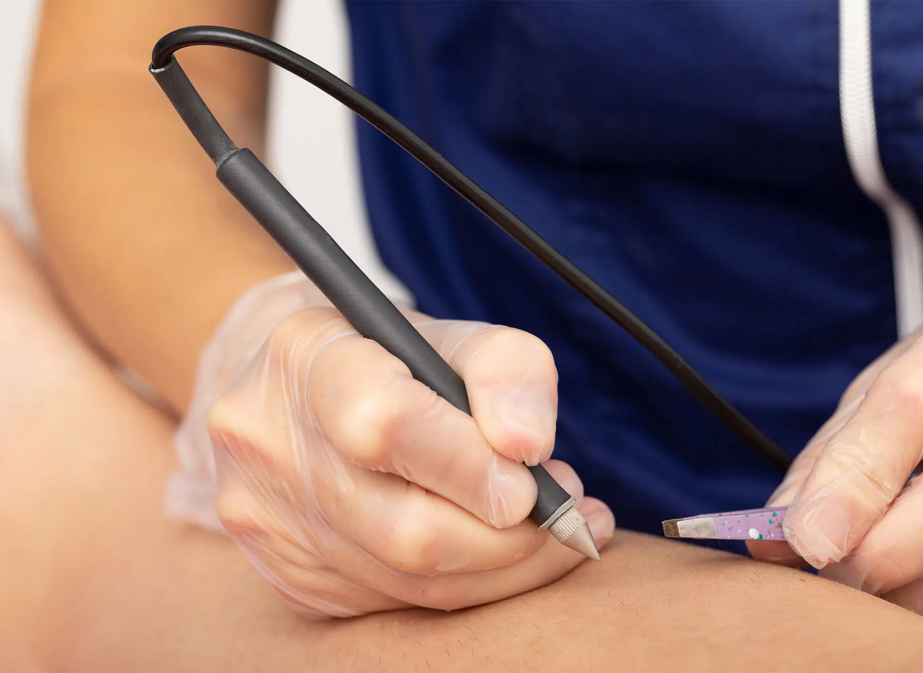 L’épilation électrique pour se débarrasser de ses poils à Paris | Dr Mayeux