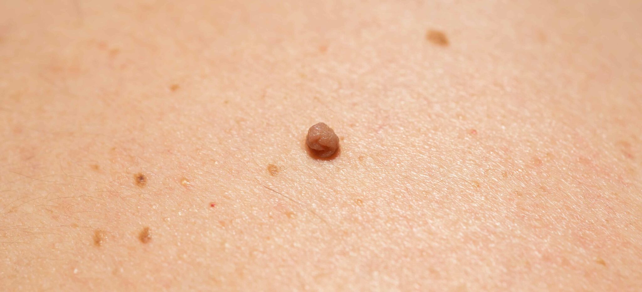 Comment se débarrasser de ses acrochordons, verrues séborrhéiques et ...