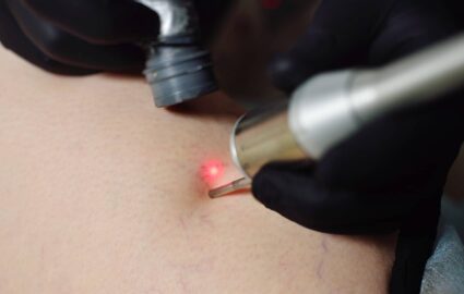 IPL : Quels sont les avantages de cet appareil 3 en 1 ? | Dr Mayeux | Paris
