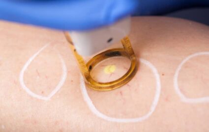 Comment éliminer les varicosités au laser ? | Dr Mayeux | Paris
