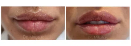 Injection de l'acide hyaluronique lèvres | Dr Mayeux | Paris