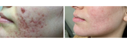 Laser CO2 | Dr Mayeux | Paris