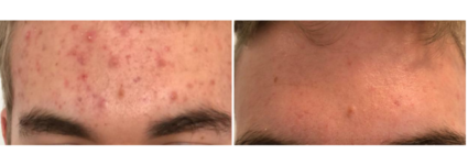 Nettoyage de peau dermatologique | Dr Mayeux | Paris