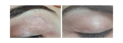 Traitement vasculaire paupières | Dr Mayeux | Paris