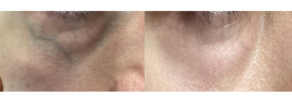 Traitement vasculaire avec NdYag | Dr Mayeux | Paris