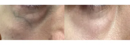 Traitement vasculaire avec NdYag | Dr Mayeux | Paris