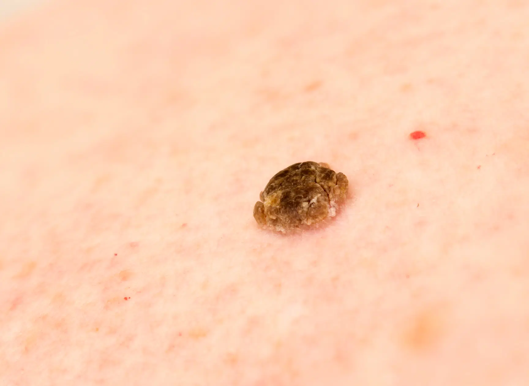 Traitement d'une kératose séborrhéique cutanée. Docteur Mayeux, Paris