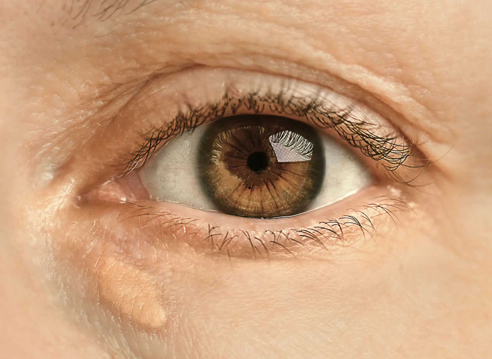 Élimination chirurgicale de plaques de xanthelasma sur les paupières. Docteur Mayeux, Paris